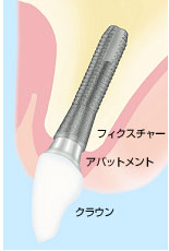 �C���v�����g �g�쎕�Ȉ�@