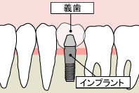 インプラント